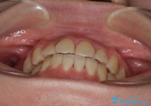 ハーフリンガル 反対咬合の改善の治療後