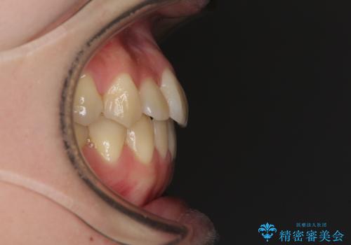 ハーフリンガル 反対咬合の改善の治療後