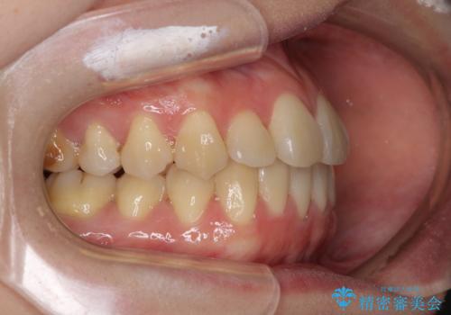 ハーフリンガル 反対咬合の改善の治療後