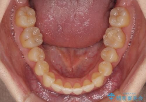 ハーフリンガル 反対咬合の改善の治療後