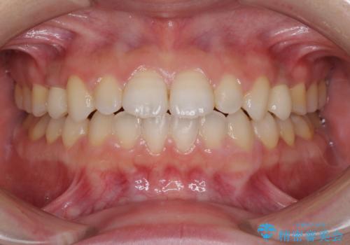 矯正治療とインプラント治療を同時に 総合歯科診療の症例 治療後