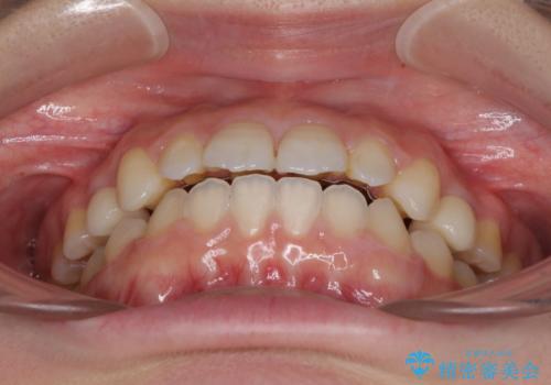 矯正治療とインプラント治療を同時に 総合歯科診療の治療後