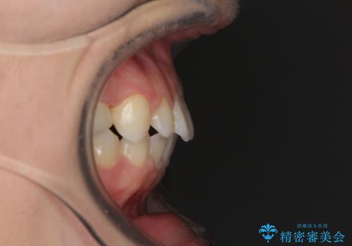 矯正治療とインプラント治療を同時に 総合歯科診療の治療後