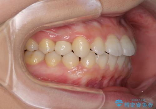 矯正治療とインプラント治療を同時に 総合歯科診療の治療後