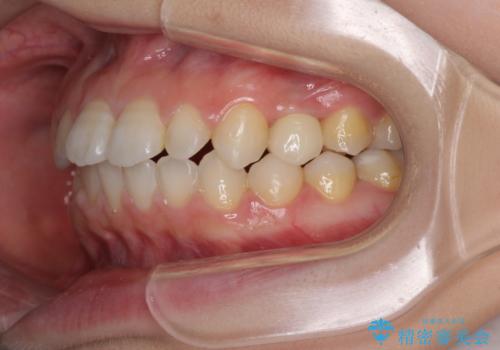 矯正治療とインプラント治療を同時に 総合歯科診療の治療後