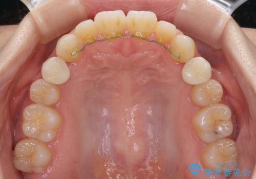 矯正治療とインプラント治療を同時に 総合歯科診療の治療後