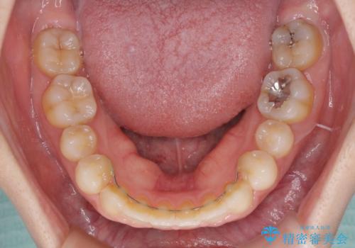 矯正治療とインプラント治療を同時に 総合歯科診療の治療後