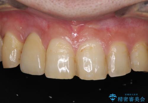 割れてしまった前歯 インプラントによる補綴治療の症例 治療後
