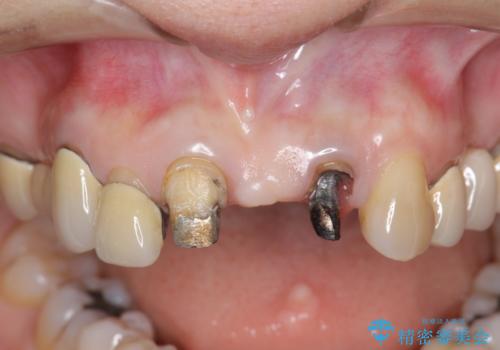 前歯ブリッジのやりかえの治療前