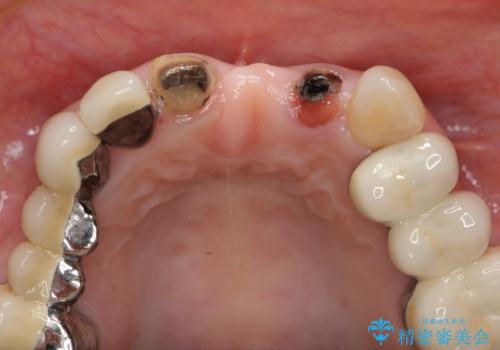 前歯ブリッジのやりかえの治療中