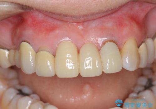 前歯ブリッジのやりかえの治療前