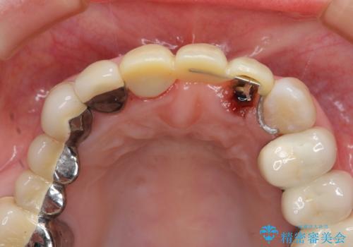 前歯ブリッジのやりかえの治療中