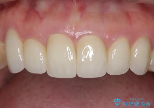 この際全てをしっかりと治療したい 総合歯科治療の治療後