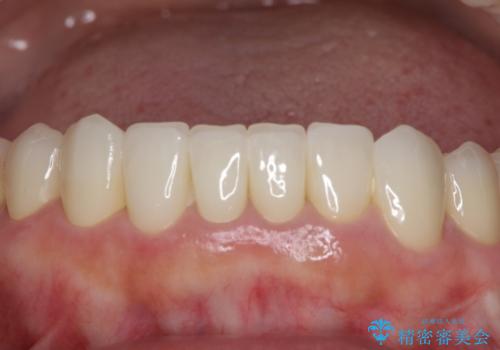 この際全てをしっかりと治療したい 総合歯科治療の治療後