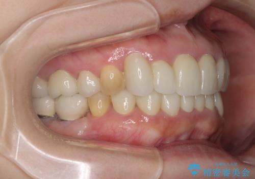 この際全てをしっかりと治療したい 総合歯科治療の治療後