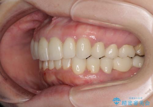 この際全てをしっかりと治療したい 総合歯科治療の治療後
