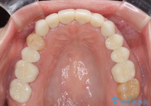 この際全てをしっかりと治療したい 総合歯科治療の治療後