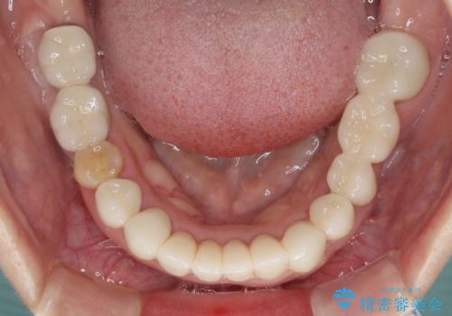 この際全てをしっかりと治療したい 総合歯科治療の治療後