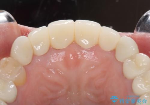 この際全てをしっかりと治療したい 総合歯科治療の治療後