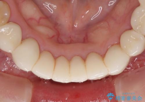 この際全てをしっかりと治療したい 総合歯科治療の治療後