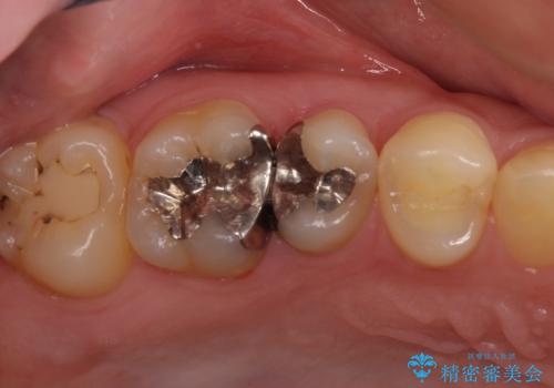 奥歯のむし歯治療　セラミックとゴールドインレーの治療前