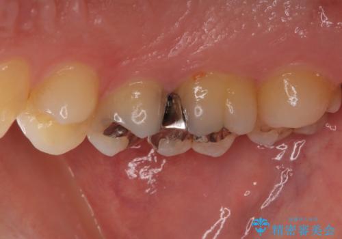 奥歯のむし歯治療 セラミックとゴールドインレーの治療前