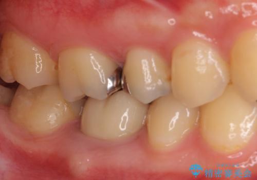 奥歯のむし歯治療 セラミックとゴールドインレーの治療前