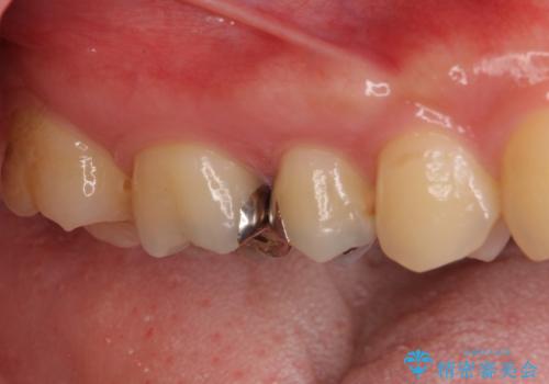 奥歯のむし歯治療 セラミックとゴールドインレーの治療前