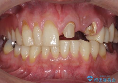 歯が折れた どうしても抜きたくない 歯の牽引で保存可能にの治療前