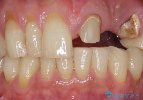 歯が折れた どうしても抜きたくない 歯の牽引で保存可能にの治療前