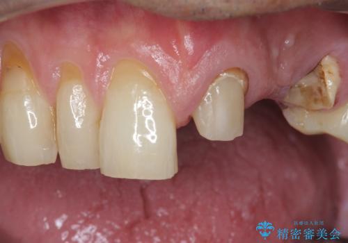歯が折れた どうしても抜きたくない 歯の牽引で保存可能にの治療前