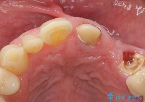 歯が折れた どうしても抜きたくない 歯の牽引で保存可能にの治療前