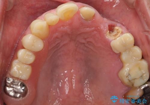 歯が折れた どうしても抜きたくない 歯の牽引で保存可能にの治療前