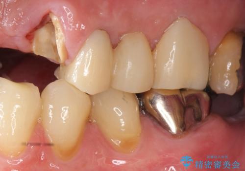 歯が折れた どうしても抜きたくない 歯の牽引で保存可能にの治療前