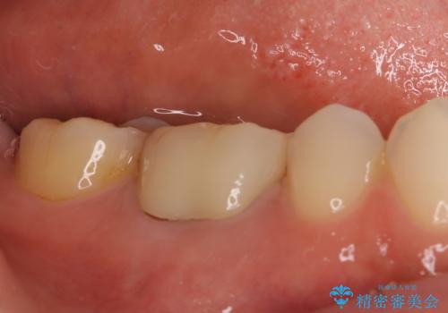金属の縁が見えてしまったクラウン オールセラミッククラウンで審美的にの治療後