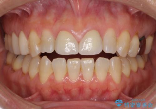前歯のすきっぱ&奥歯の虫歯　セラミッククラウンで徹底的に治すの症例 治療後