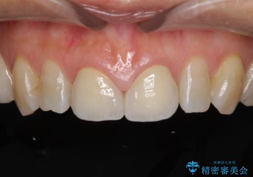 前歯のすきっぱ&奥歯の虫歯 セラミッククラウンで徹底的に治すの治療後