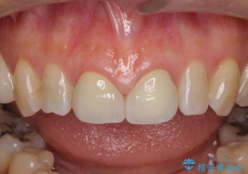 前歯のすきっぱ&奥歯の虫歯　セラミッククラウンで徹底的に治すの治療後
