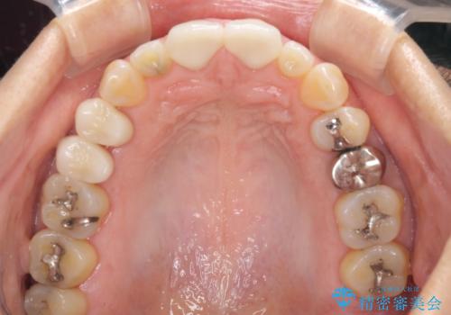 前歯のすきっぱ&奥歯の虫歯 セラミッククラウンで徹底的に治すの治療後