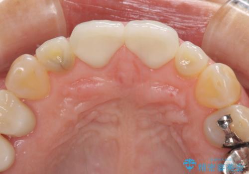前歯のすきっぱ&奥歯の虫歯 セラミッククラウンで徹底的に治すの治療後