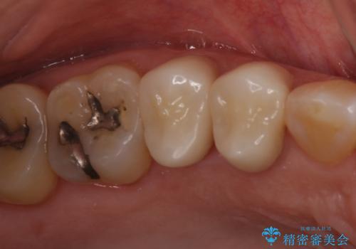 前歯のすきっぱ&奥歯の虫歯　セラミッククラウンで徹底的に治すの治療後