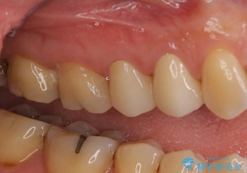 前歯のすきっぱ&奥歯の虫歯 セラミッククラウンで徹底的に治すの治療後