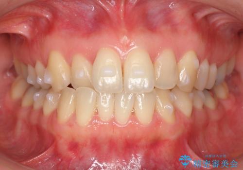 上の前歯が一部引っ込んでいる 下のがたがた マウスピース矯正の治療中