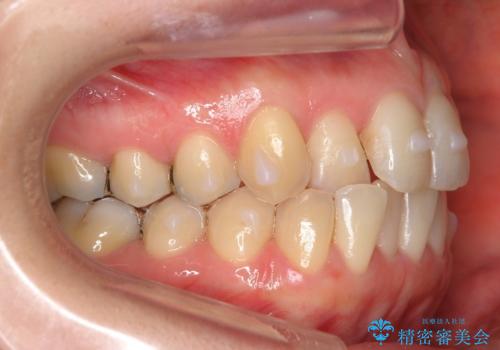 上の前歯が一部引っ込んでいる 下のがたがた マウスピース矯正の治療中