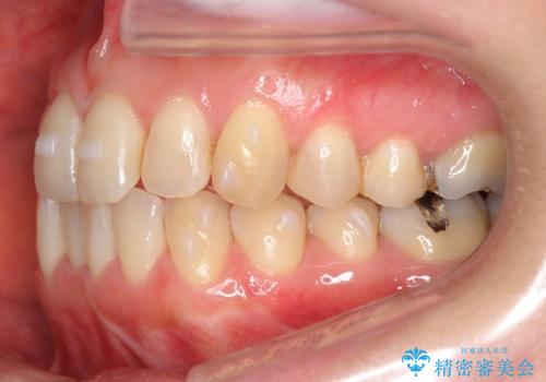 上の前歯が一部引っ込んでいる 下のがたがた マウスピース矯正の治療中