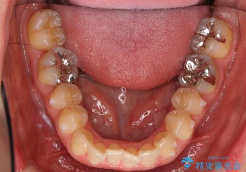 上の前歯が一部引っ込んでいる 下のがたがた マウスピース矯正の治療中