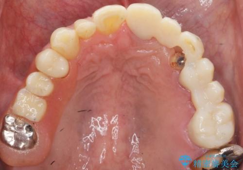 歯が折れた どうしても抜きたくない 歯の牽引で保存可能にの治療中