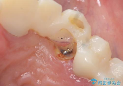 歯が折れた どうしても抜きたくない 歯の牽引で保存可能にの治療中