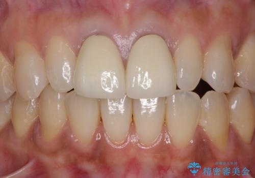 前歯をメタルフリーに　根管治療で不安を取り除いてからの治療後