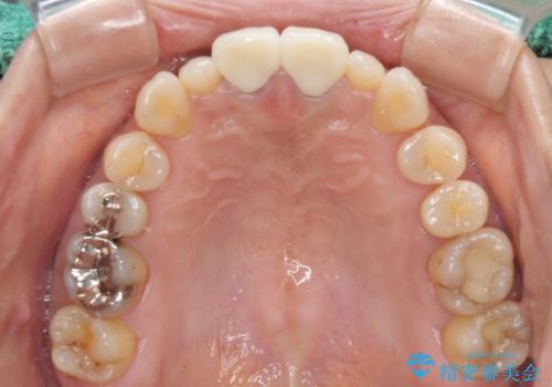 前歯をメタルフリーに　根管治療で不安を取り除いてからの治療後